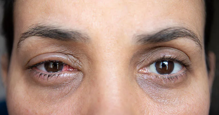 An image of a woman going through recovery from eye surgery.