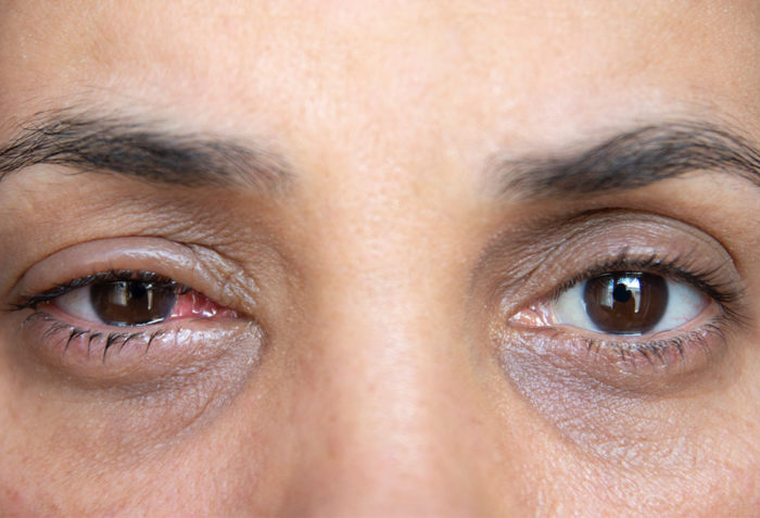 How To Tell The Difference Between Pink Eye And A Stye