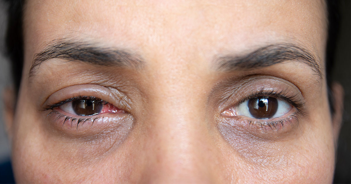 How To Tell The Difference Between Pink Eye And A Stye