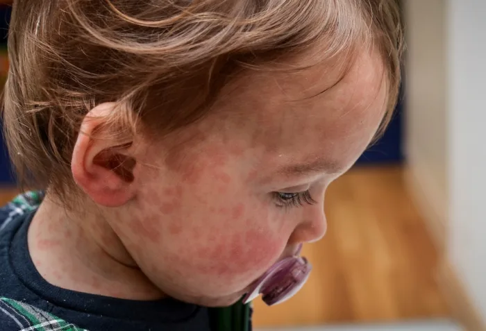 An enlarged image of a child with measles on their face.
